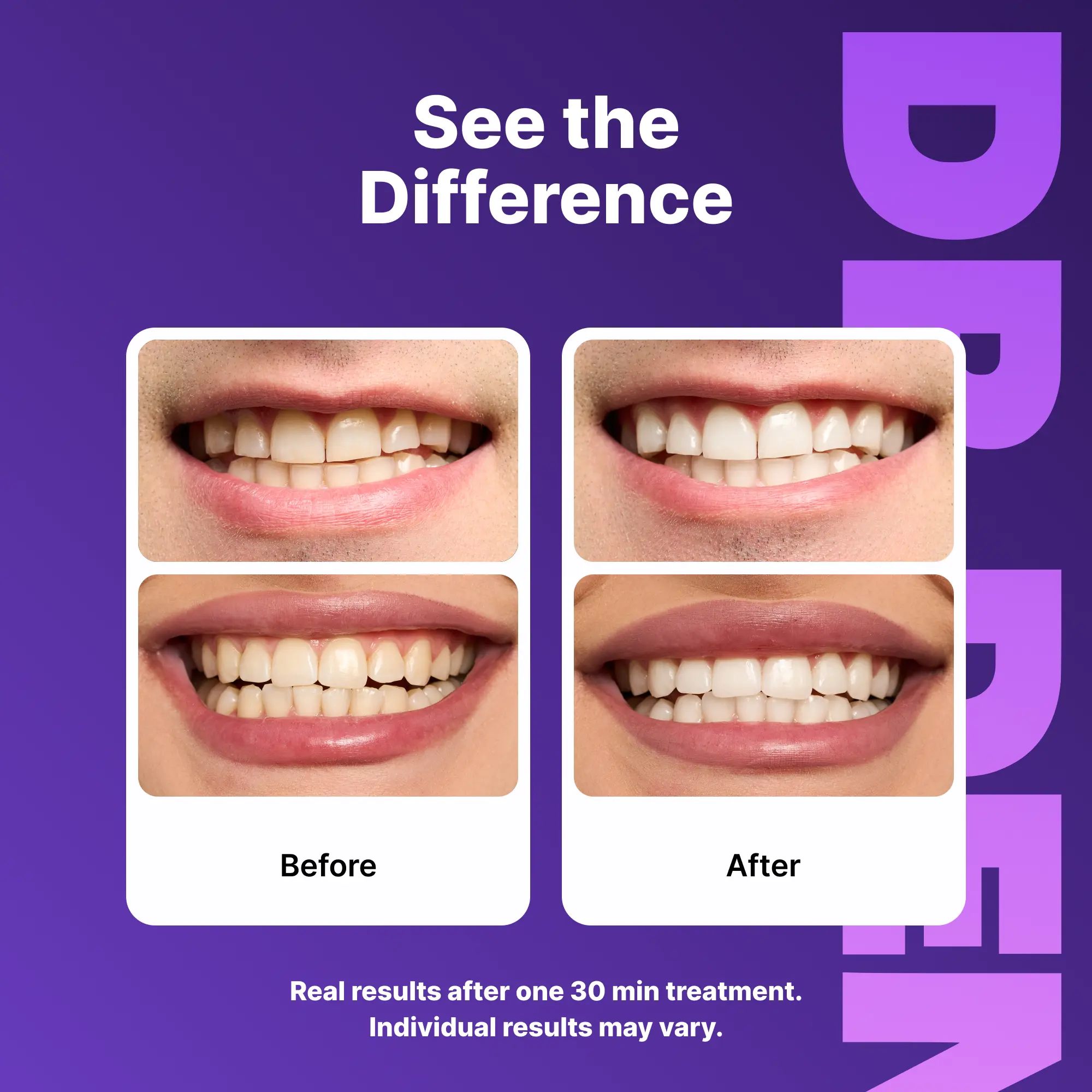 Purple Smile Brightening Strips